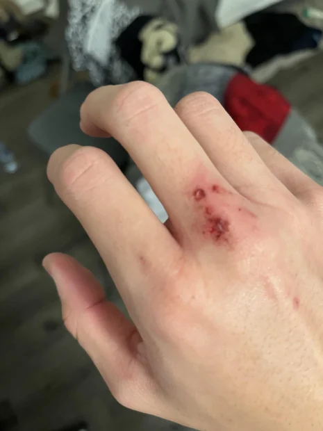 kutyaharapás, harapás, kutyaharapás kezelése, kutyaharapás gyógyulási ideje, kutyaharapás mikor forduljunk orvoshoz, kutyaharapás utáni tünetek, kutyaharapás megelőzése